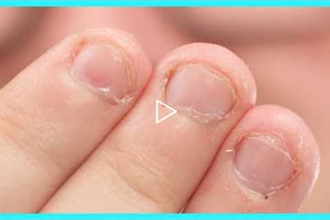 Fix Bitten Nails and Avoid Allergies with My Hack!