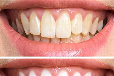 Does Teeth Whitening Damage Enamel? An Expert's Perspective