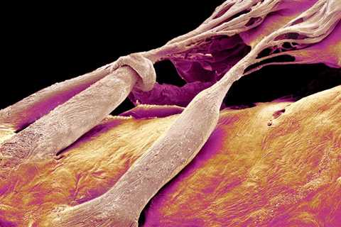New Treatment Could Help Fix the Heart’s ‘Forgotten Valve’