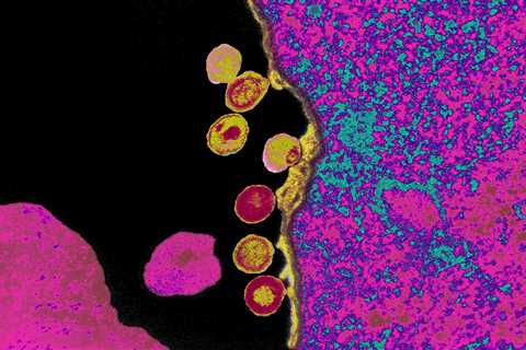 Another Patient Is Free of HIV after Receiving Virus-Resistant Cells