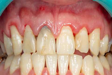 What is a Periodontal Pocket and How to Treat It