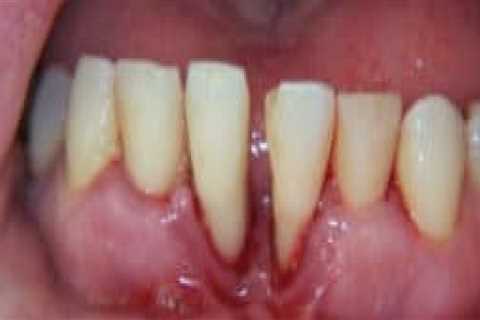 Can You Fix Severe Periodontal Disease?