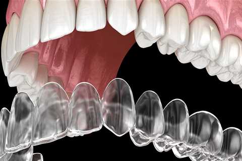 Why is Invisalign More Expensive than Other Orthodontic Treatments?