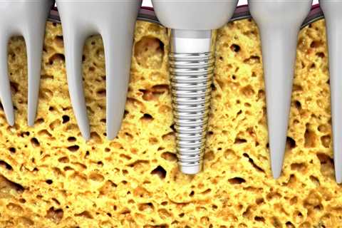 A Look Into Advanced Endodontics: Why Choose Dental Implants For Replacing Missing Teeth In Austin, ..