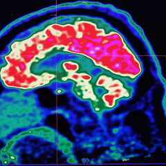 New Research Points to Causes for Brain Disorders with No Obvious Injury