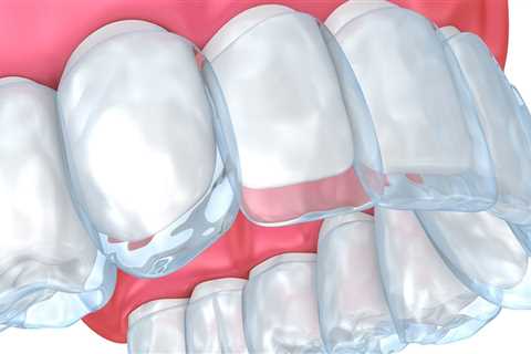 Where to Find the Best Invisalign® Treatment in Nashville, TN