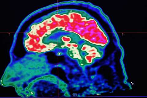New Research Points to Causes for Brain Disorders with No Obvious Injury