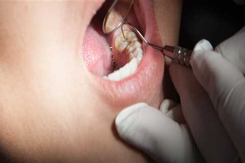 Exploring The Process Of Veneers For Tooth In Conroe, TX With The Help Of Medical Imaging