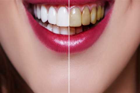 What is the Average Cost of Veneers at a Dentist's Office in Nashville, TN?