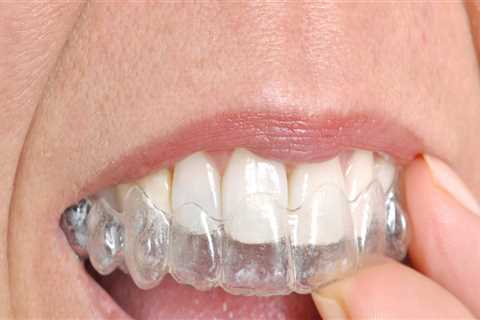The Connection Between Endodontics And Invisalign: Achieving A Perfect Smile In Cedar Park