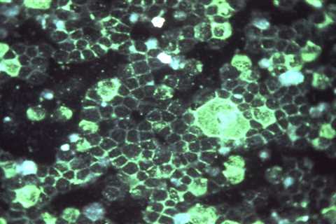J&J Portfolio Review Culls RSV Vaccine, Ending the Phase 3 Program