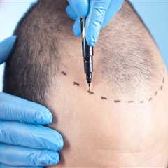 Navigating Hair Restoration: How A Health Consultant Can Guide You Through FUT Transplantation In..