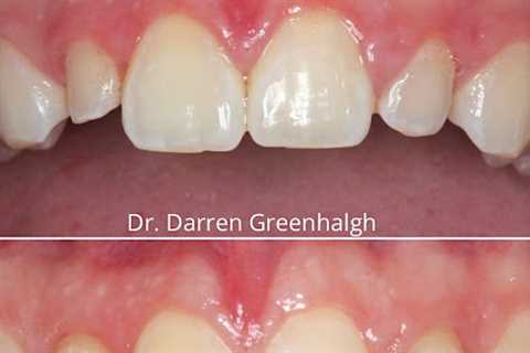 Implant Dentistry Mill Creek, WA