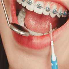 Ensuring Dental Safety with Braces in Stafford, VA