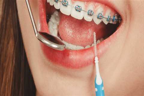 Ensuring Dental Safety with Braces in Stafford, VA